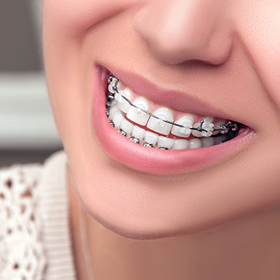 Dentofacial orthopedics/Aligners 2